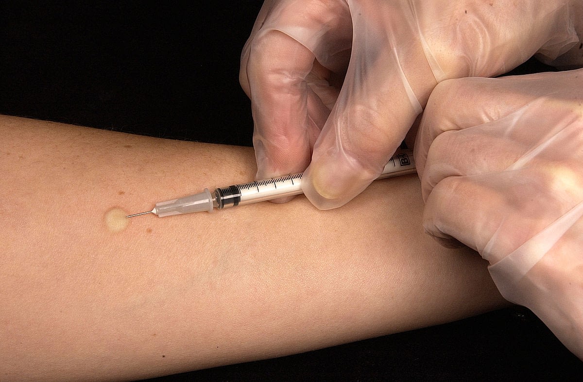 Intradermal skin test